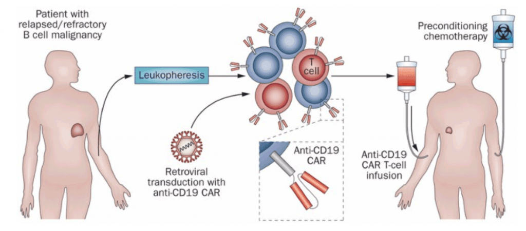Car T-Cell infusion for acute lymphocytic leukemia and lymphoma containing a B-cell antigen B