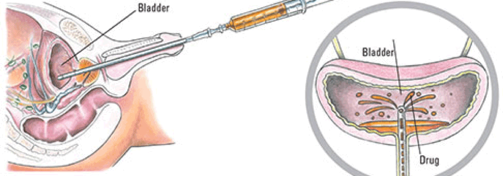 Insertion of BCG incite an immune response in the urinary bladder