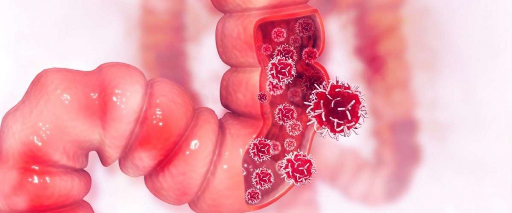 drdonaldpoon_colorectal-cancer-symptoms-treatment-and-screening